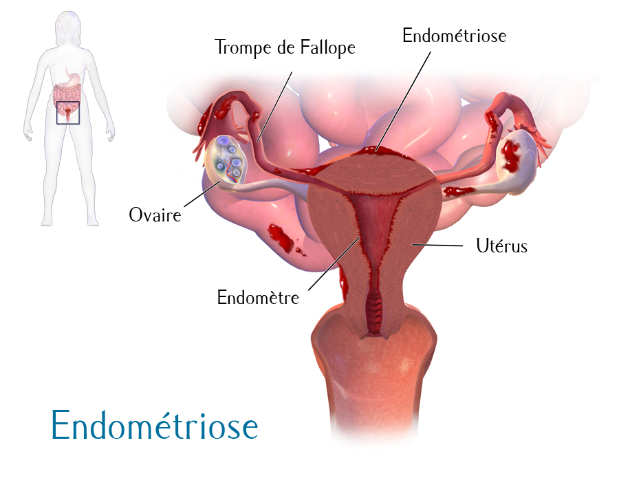 Nutri Endo soigne l'endométriose