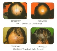 follon chute des cheveux