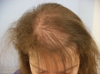 follon chute des cheveux