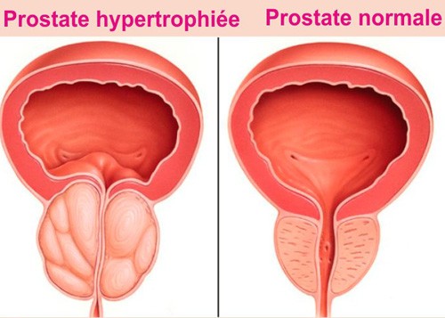 prostate botavie