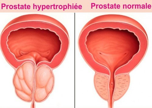 Les plantes et la prostate