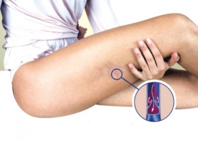 Circulation et jambes lourdes