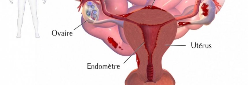 Endométrisose - Les symptômes
